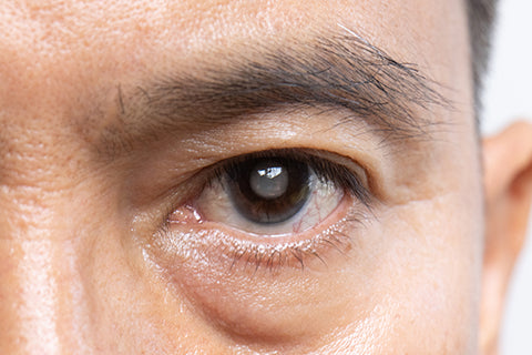 A person's dark brown eye with a cataract visible